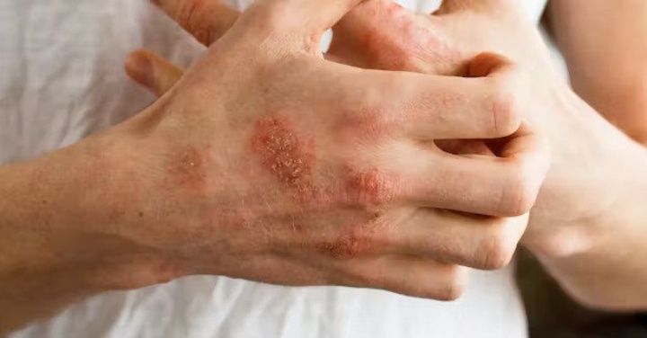 راش پوستی قرمز و ناهموار از علائم تب روماتیسمی