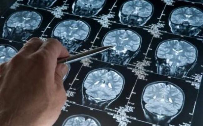 پیشرفت چشمگیر در تشخیص زودهنگام بیماری آلزایمر با استفاده از هوش مصنوعی