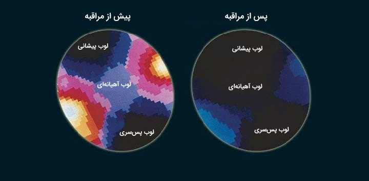 مراقبه چیست ، تاثیر مراقبه بر مغز