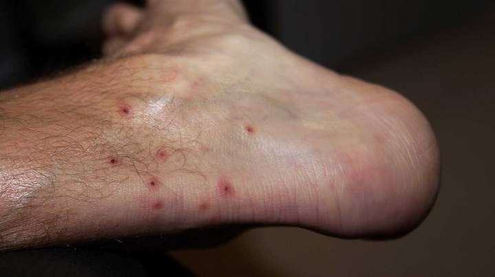 تشخیص جای نیش حشرات گوناگون و نحوه درمان آنها_ساحل دانش 48 نیش چیگرز