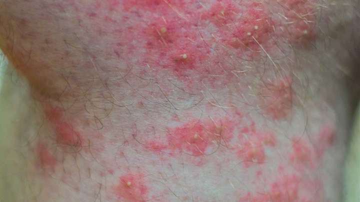 تشخیص جای نیش حشرات گوناگون و نحوه درمان آنها_ساحل دانش 43 نیش مورچههای آتشین