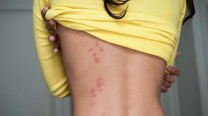 تشخیص جای نیش حشرات گوناگون و نحوه درمان آنها_ساحل دانش 45 نیش ساس
