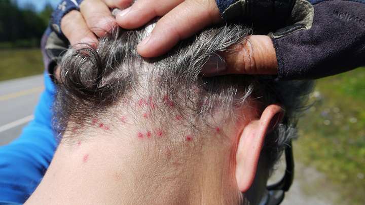 تشخیص جای نیش حشرات گوناگون و نحوه درمان آنها_ساحل دانش 46 نیش مگس