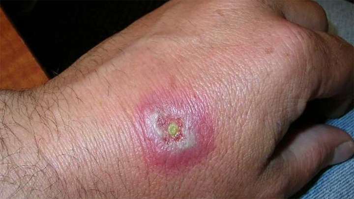 تشخیص جای نیش حشرات گوناگون و نحوه درمان آنها_ساحل دانش 53 نیش عنکبوت بیوه سیاه
