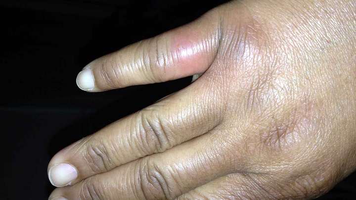 تشخیص جای نیش حشرات گوناگون و نحوه درمان آنها_ساحل دانش 52 نیش عنکبوت قهوهای